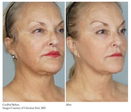 Coopeel After & before Treatment | Synergy Wellness MediSpa in Red Bank, NJ