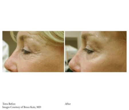 Tetra After & before Treatment | Synergy Wellness MediSpa in Red Bank, NJ