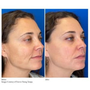 Before-and-After Virtue RF Microneedling | Synergy Wellness MediSpa in Red Bank, NJ