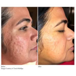 Before-and-After Virtue RF Microneedling | Synergy Wellness MediSpa in Red Bank, NJ