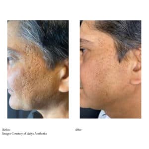 Before-and-After Virtue RF Microneedling | Synergy Wellness MediSpa in Red Bank, NJ