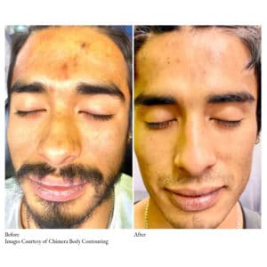 Before-and-After Virtue RF Microneedling | Synergy Wellness MediSpa in Red Bank, NJ
