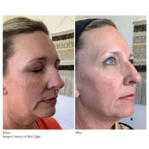 Before-and-After Virtue RF Microneedling | Synergy Wellness MediSpa in Red Bank, NJ
