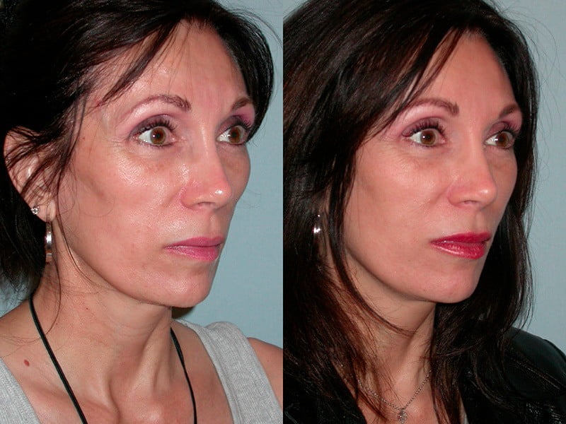 Sculptra Before & After Pictures | Synergy Wellness MediSpa in Red Bank, NJ