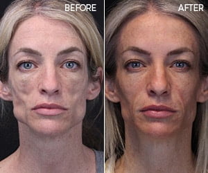 Sculptra Before & After Pictures | Synergy Wellness MediSpa in Red Bank, NJ