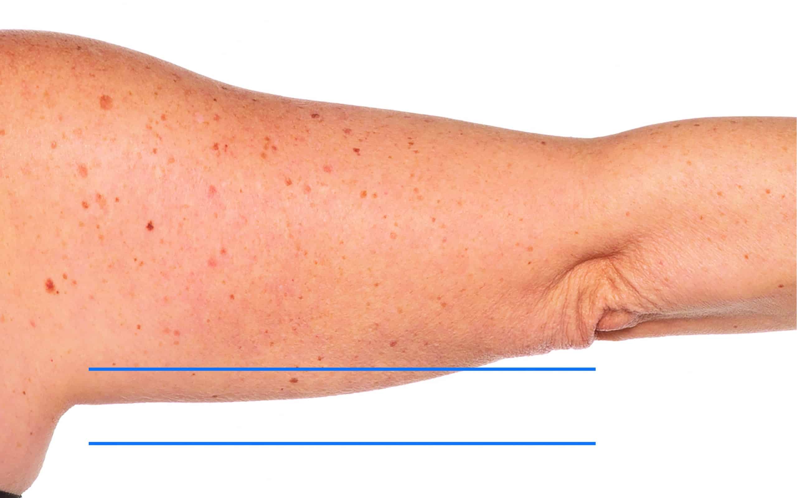 Saggy upper arm After treatment | Synergy Wellness MediSpa in Red Bank, NJ