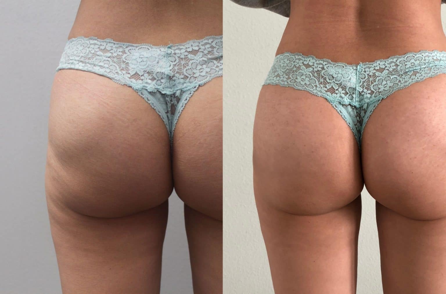 Butt Lift Before & After Pictures | Synergy Wellness MediSpa in Red Bank, NJ
