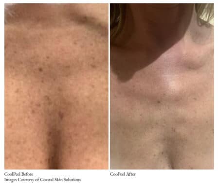 a comparison of a woman's chest and chest before and after | coolpeel before and after pictures | Oceanport, NJ