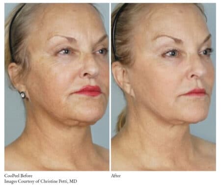 a woman before and after a plastic surgery | Synergy Wellness MediSpa