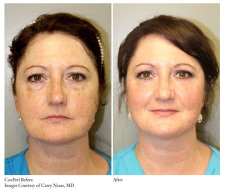 a woman before and after a surgery - cool peel before and after pictures | Oceanport, NJ