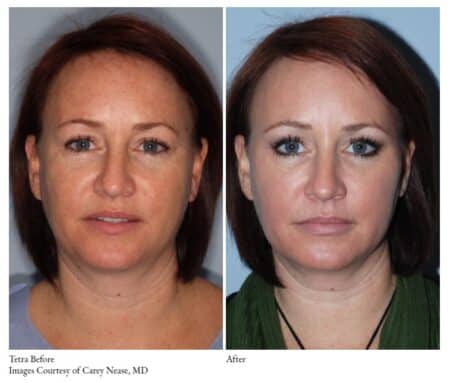 a comparison of a woman's face | Tetra Co2 Laser before after picture | Oceanport, NJ