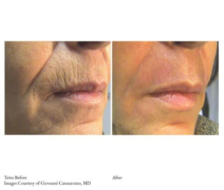 close-up of a woman's face before and after her lip surgery