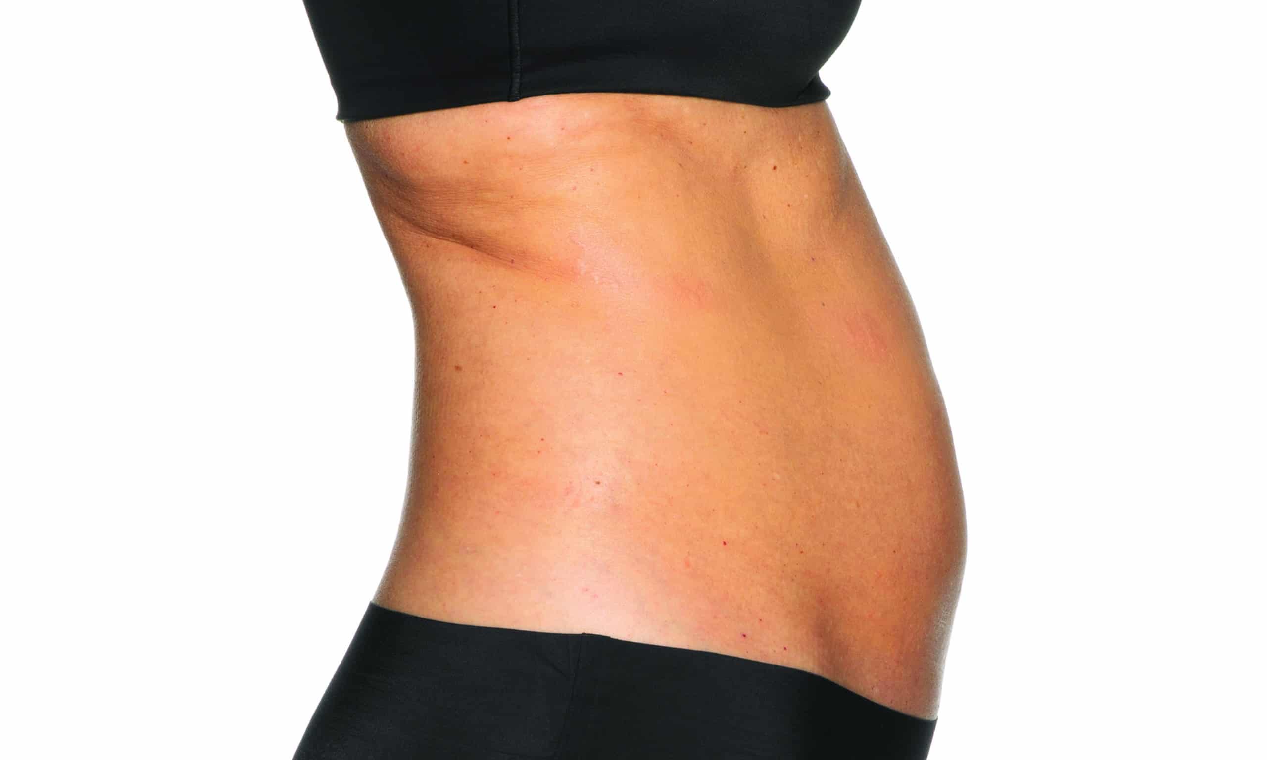 Abdomen_BEFORE a close-up of a woman's belly - Abdomen BEFORE | Synergy Wellness and Medispa | Oceanport, NJ