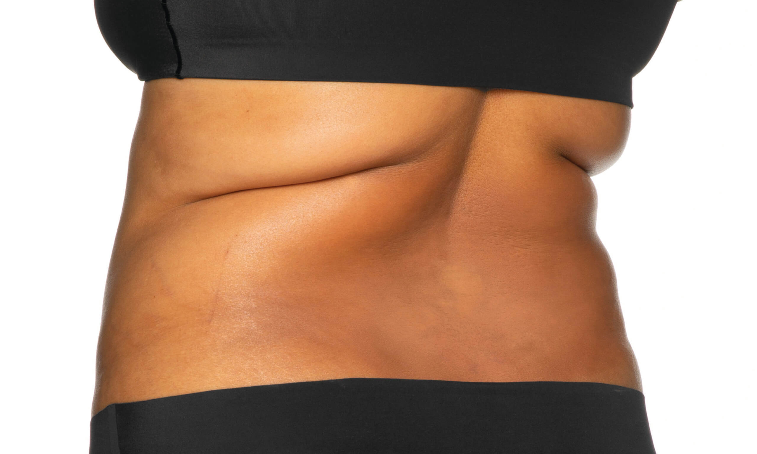 Coolsculpting Elite Before Treatment Bra Area & Flanks | Synergy Wellness MediSpa in Oceanport, NJ a close-up of a woman's belly in Oceanport, NJ