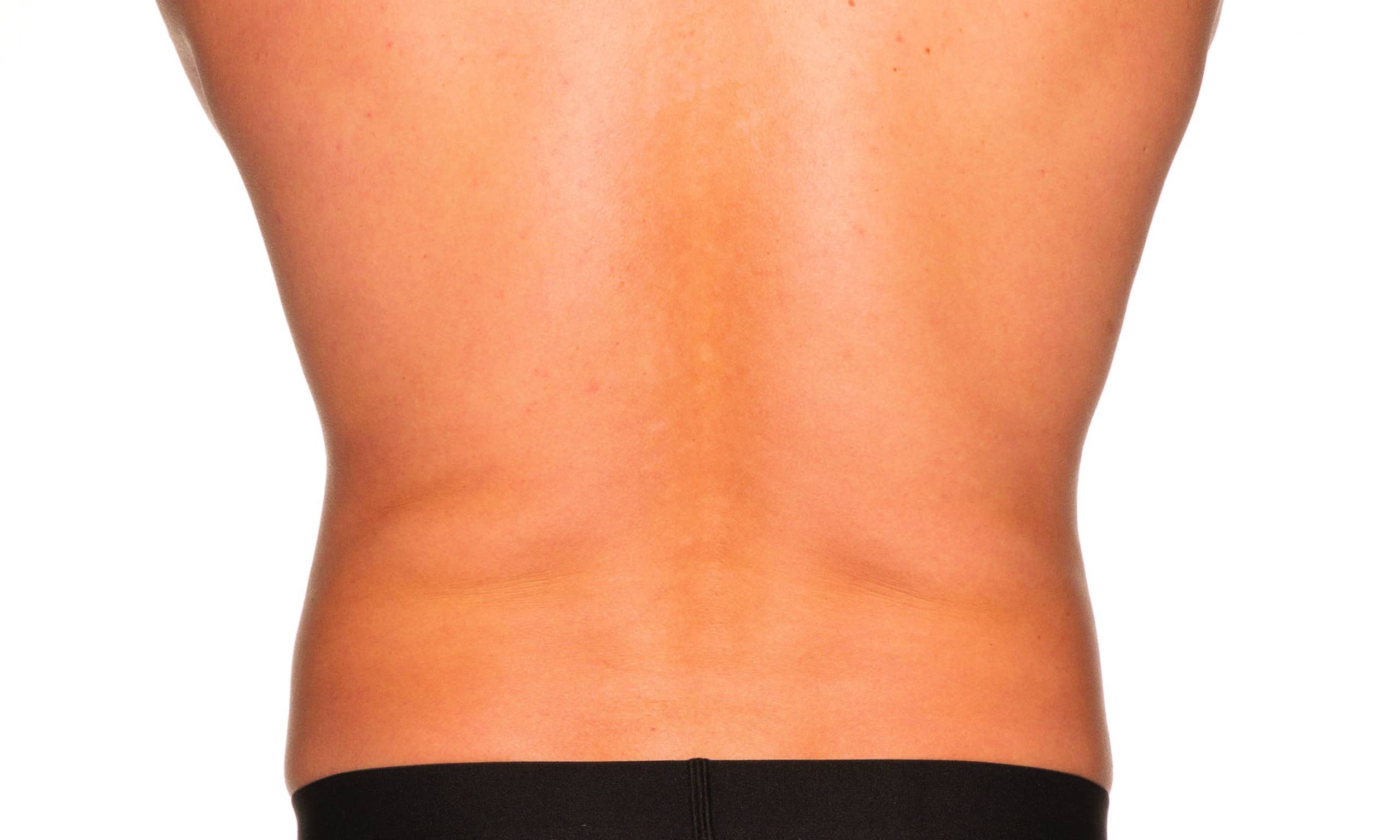 the back of a man's back | Flanks Loven Handles | Synergy Wellness and Medispa | Oceanport, NJ