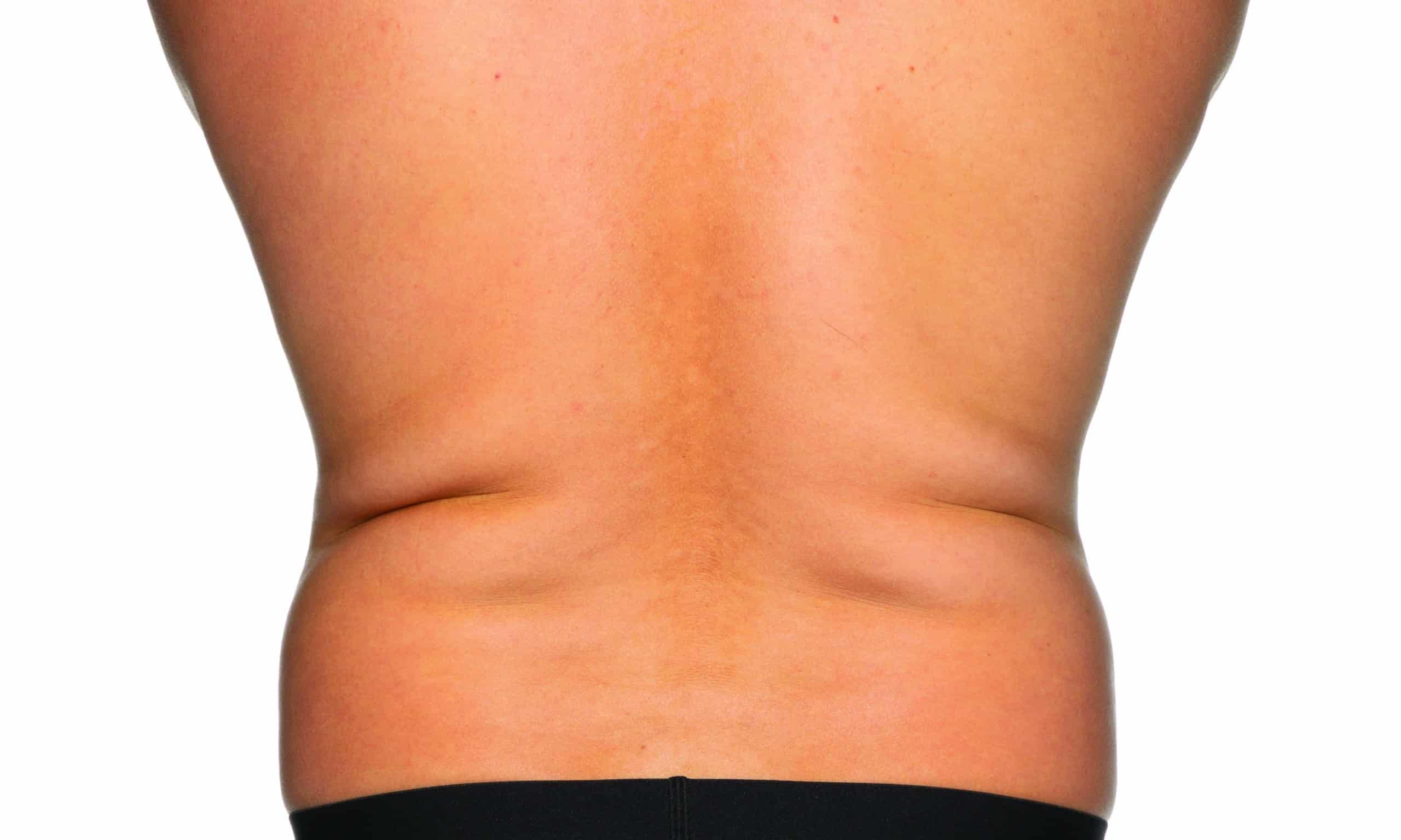 Flanks_Love_Handles_BEFORE the back of a person's back - Flanks Love Handles BEFORE | Synergy Wellness and Medispa | Oceanport, NJ