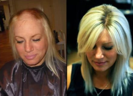 a comparison of a woman's hair loss - Hair-Restoration Before & After Pictures | Synergy Wellness MediSpa in Oceanport, NJ