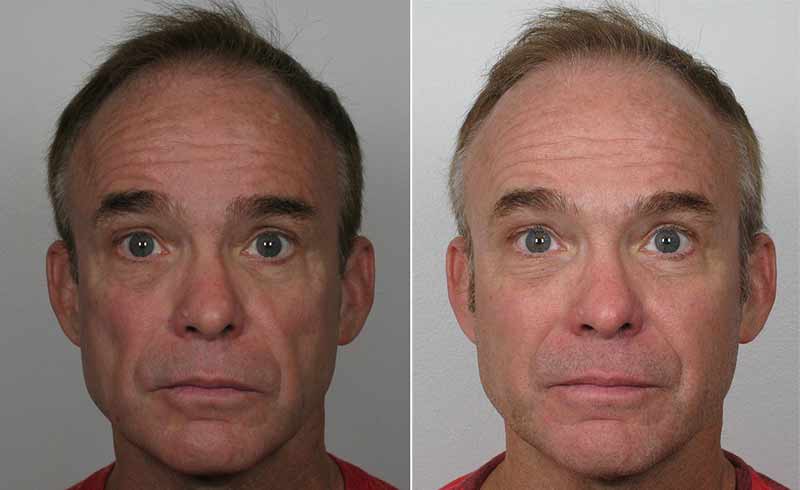 a man with a surprised expression - Sculptra Before & After Pictures | Synergy Wellness MediSpa in Oceanport, NJ