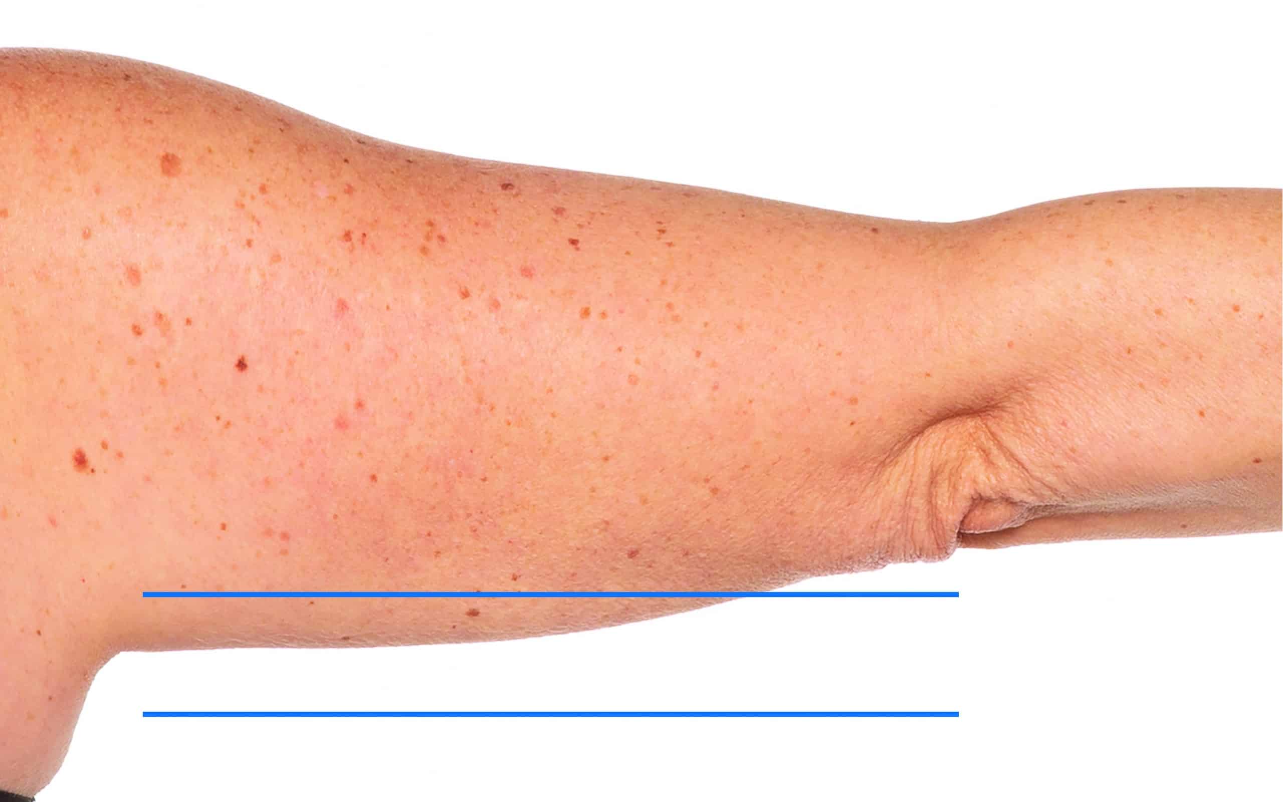 a close up of a person's arm - Saggy upper arm After treatment | Synergy Wellness MediSpa in Oceanport, NJ