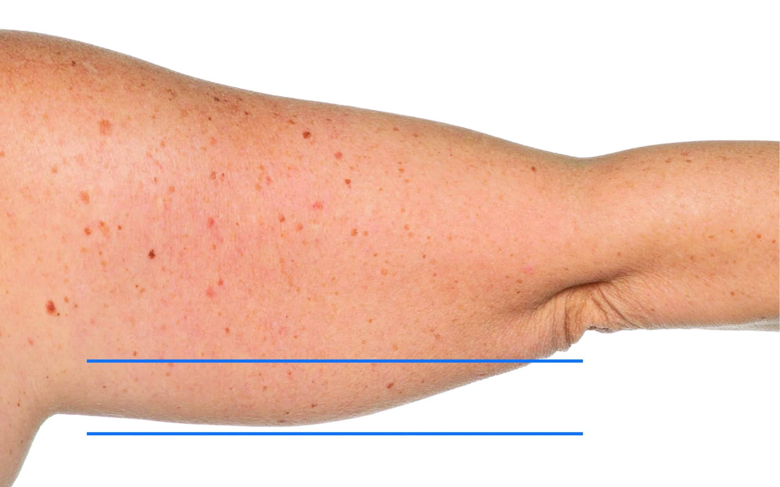 Saggy upper arm Before treatment | Synergy Wellness MediSpa in Oceanport, NJ a close up of a person's arm - Saggy upper arm Before treatment | Synergy Wellness MediSpa in Oceanport, NJ