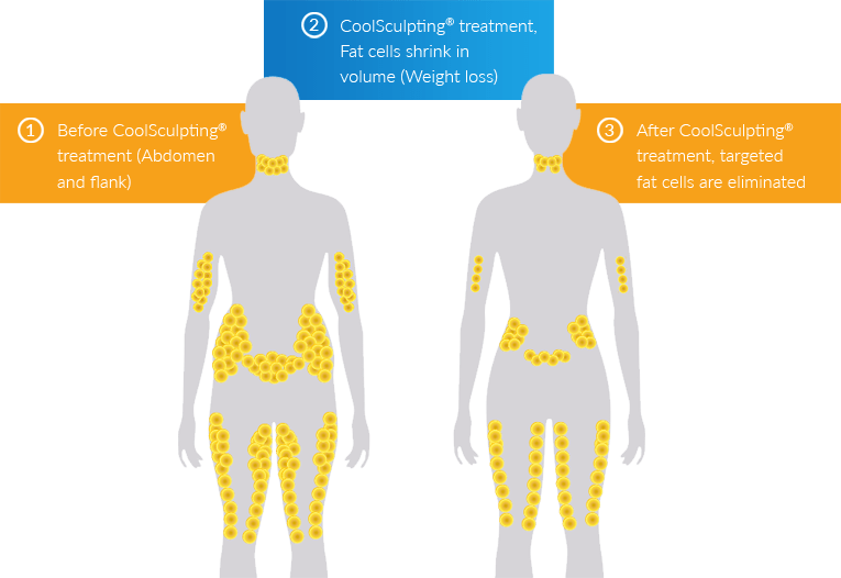 a comparison of a person's body | Coolsculpting® Elite, Science Before & After Pictures | Synergy Wellness MediSpa in Oceanport, NJ