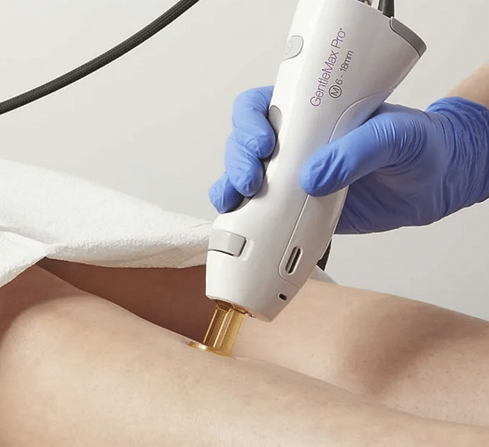 a person getting laser treatment on their leg | Aesthetician Epilating GentleMax-Pro Laser on Female's Legs for Removing Hair | Synergy Wellness MediSpa in Oceanport, NJ